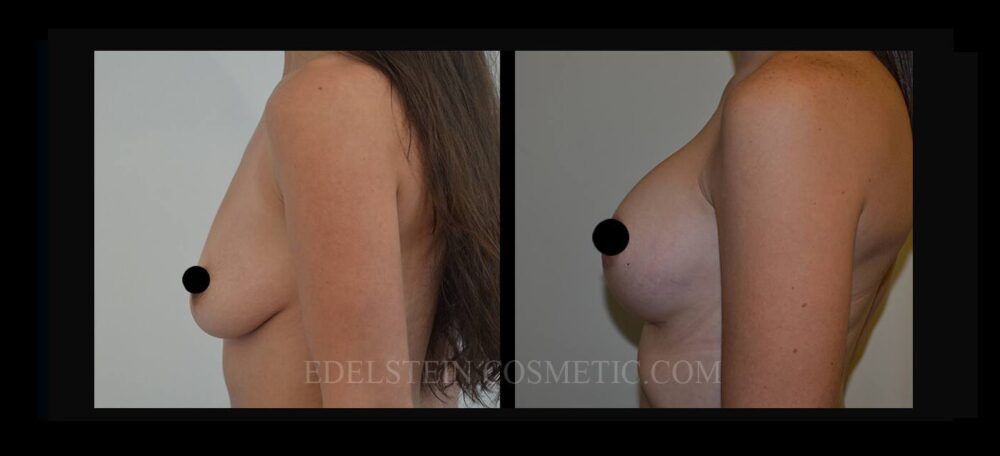 Breast Augmentation case #26695