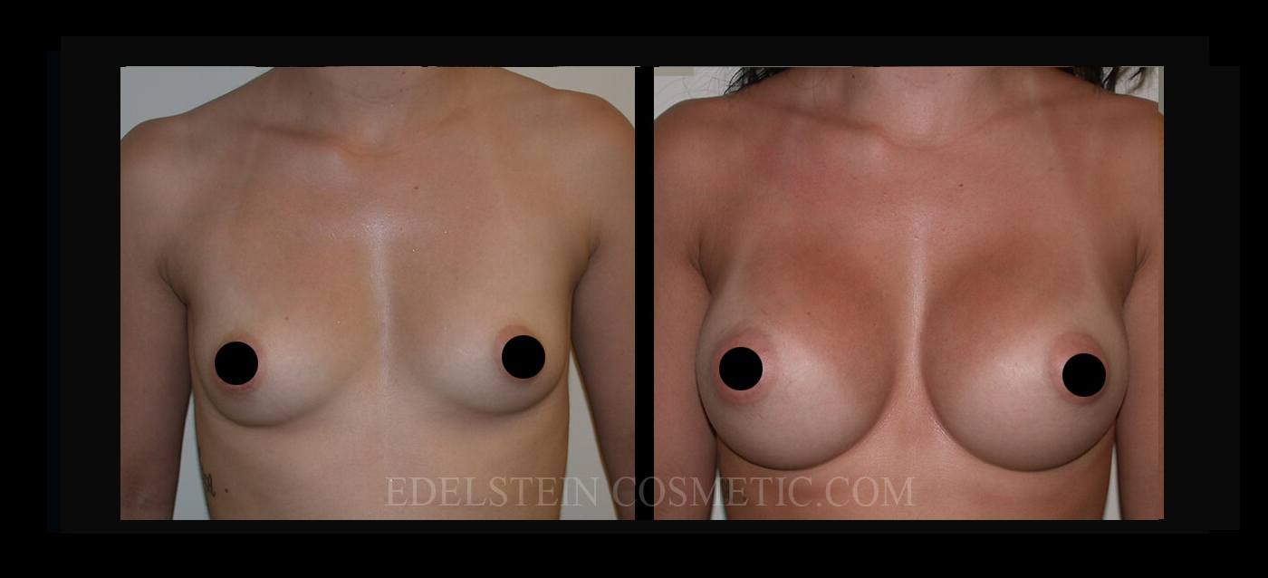 Breast Augmentation case #26694