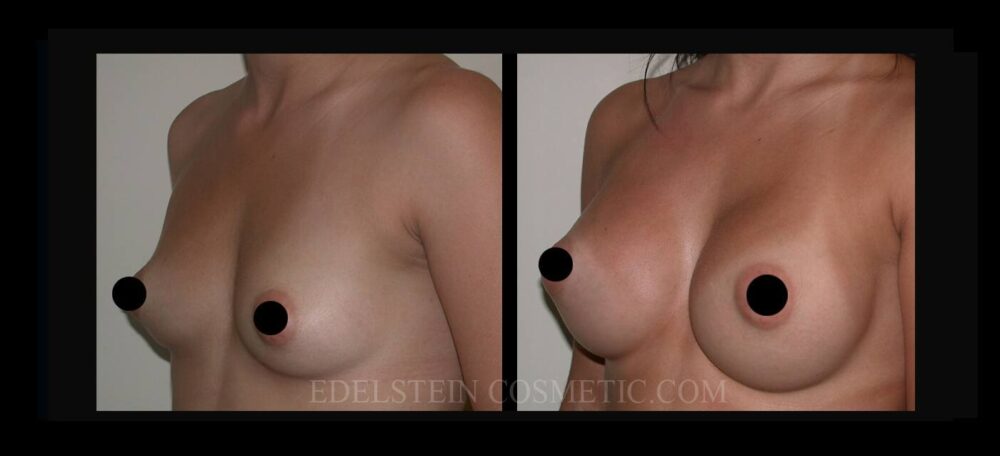 Breast Augmentation case #26694