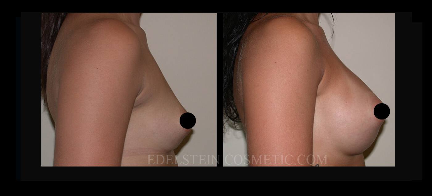 Breast Augmentation case #26694