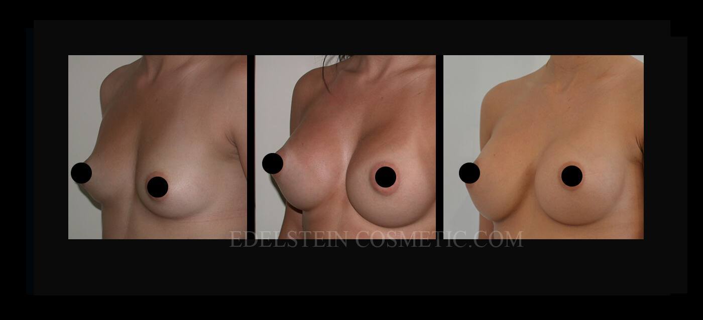 Breast Augmentation case #26692