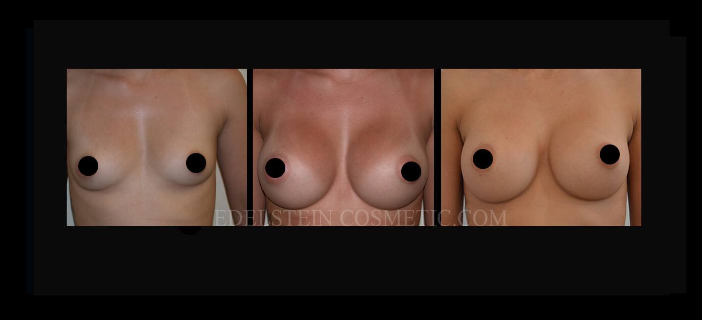 Breast Augmentation case #26692