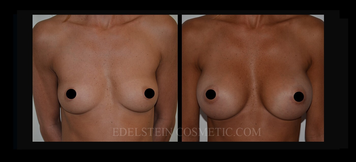 Breast Augmentation case #26684