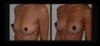 Breast Augmentation case #26690 slider thumbnail