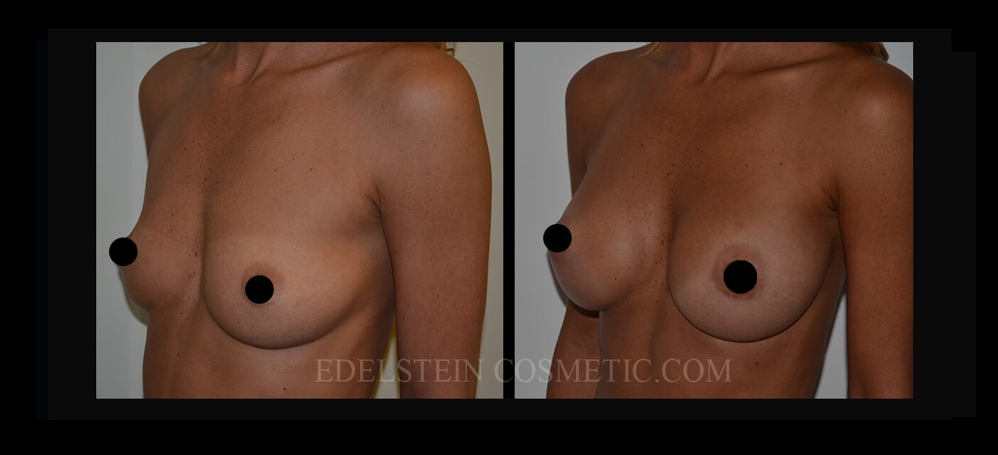 Breast Augmentation case #26684