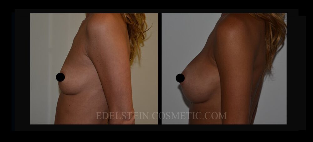 Breast Augmentation case #26684