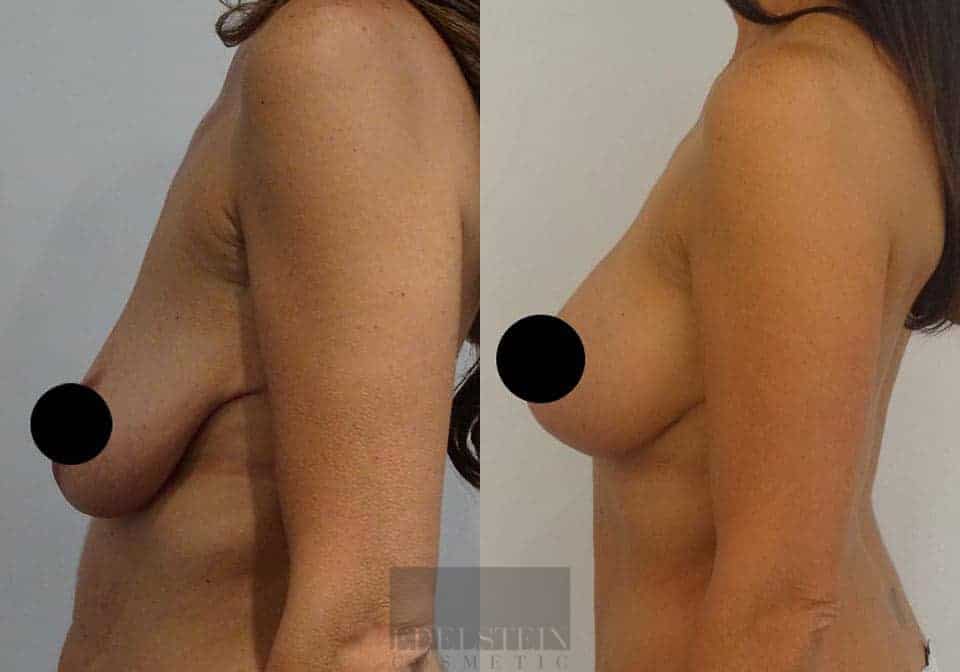 Breast Lift case #26653