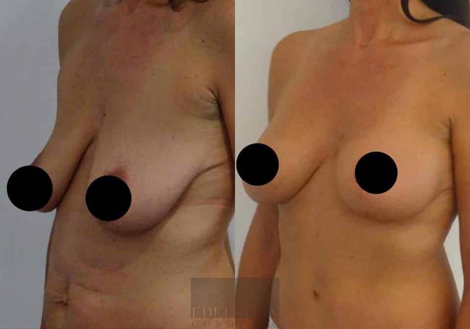 Breast Lift case #26653