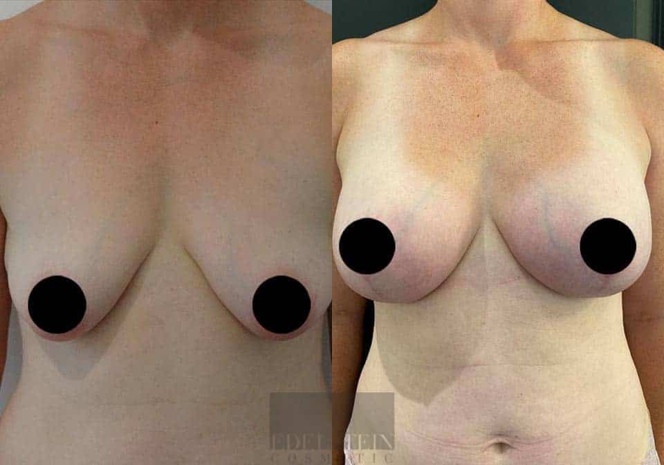 Breast Lift case #26652