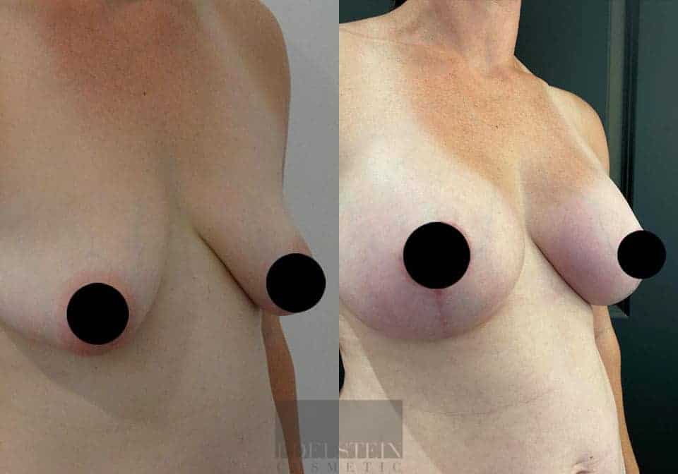 Breast Lift case #26652