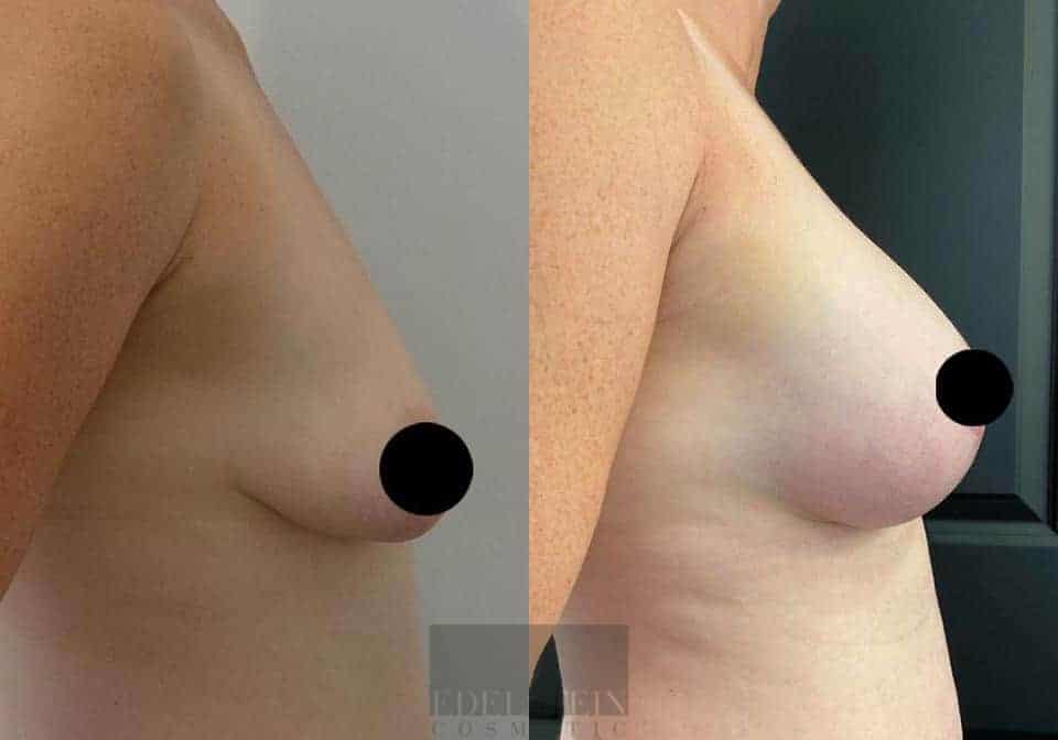 Breast Lift case #26652