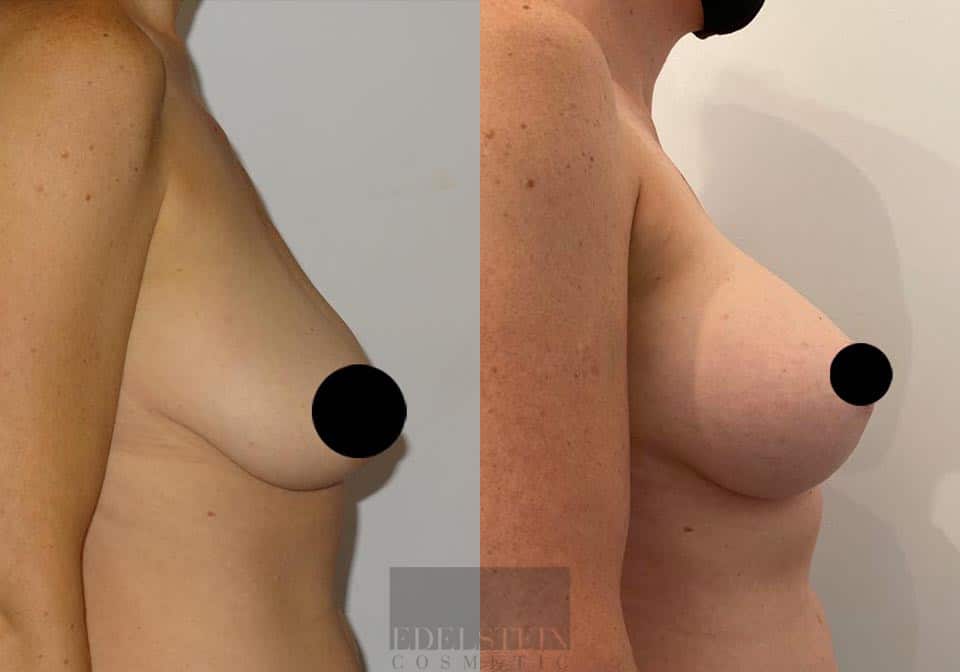 Breast Lift case #26651