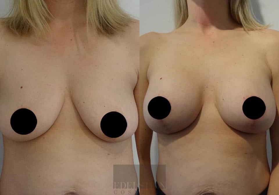 Breast Lift case #26650