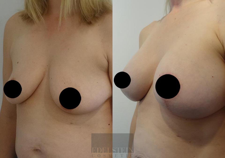 Breast Lift case #26650