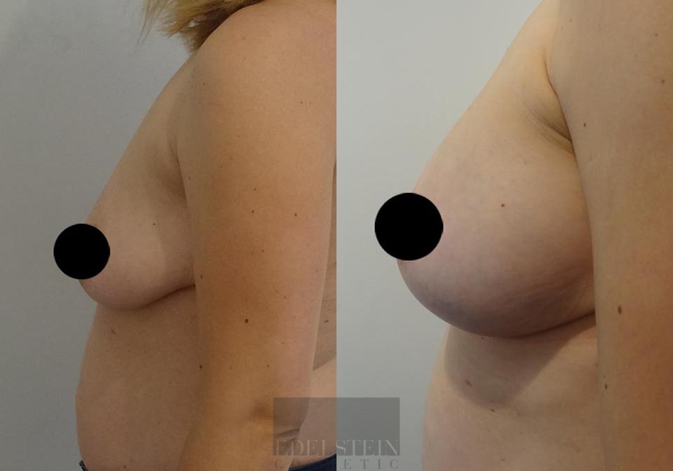 Breast Lift case #26650