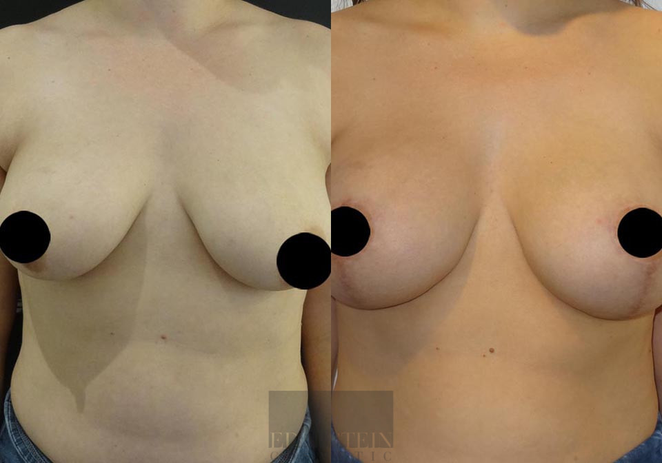 Breast Lift case #26647