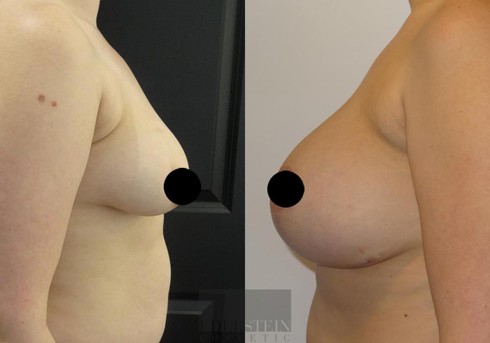 Breast Lift case #26647