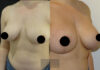 Breast Lift case #26647 slider thumbnail