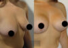 Breast Lift case #26646 slider thumbnail