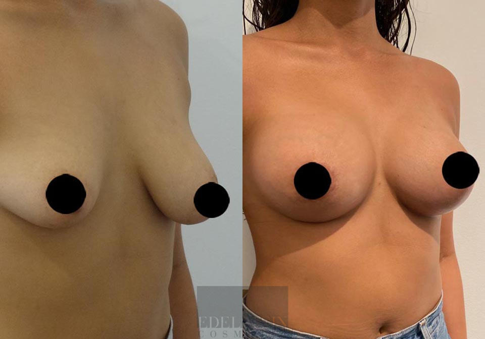 Breast Lift case #26645