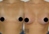 Breast Lift case #26644 slider thumbnail