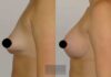 Breast Lift case #26644 slider thumbnail