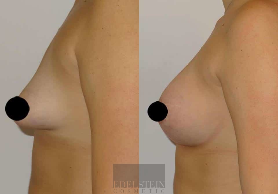 Breast Lift case #26644