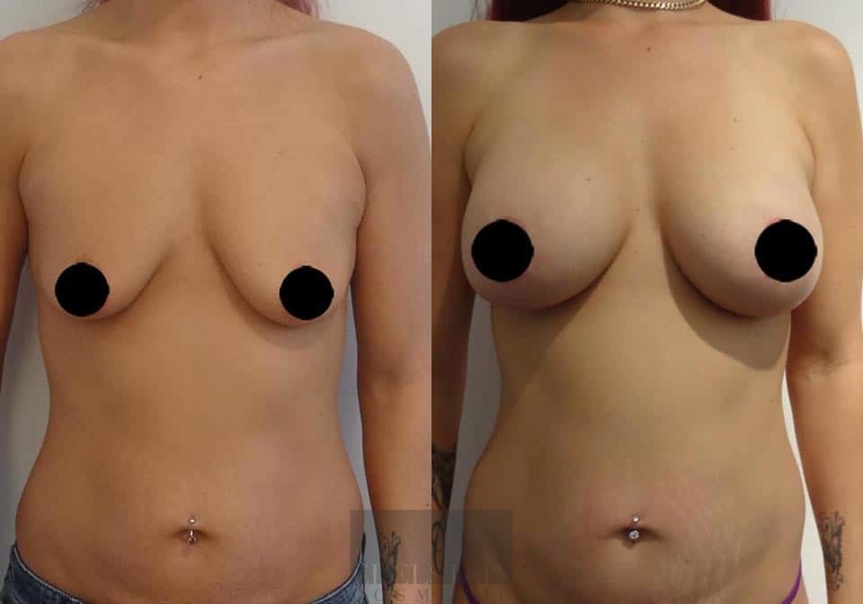 Breast Lift case #26643