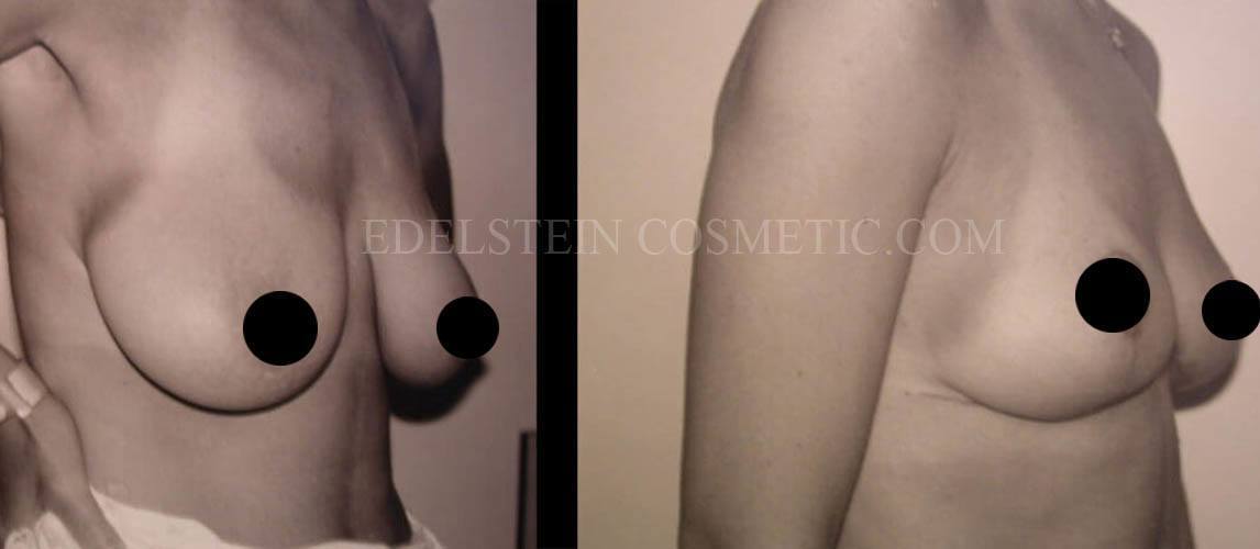 Breast Lift case #26649