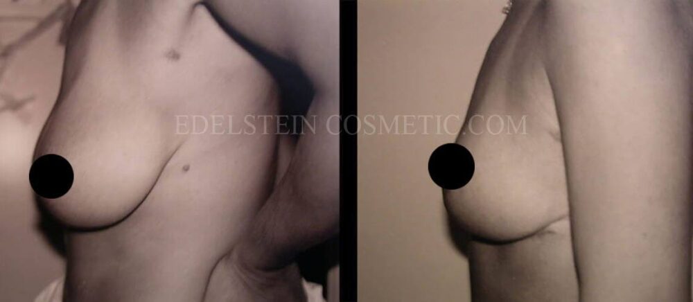 Breast Lift case #26649