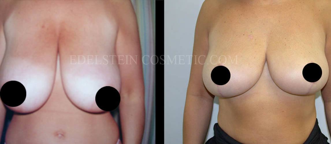 Breast Lift case #26648