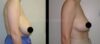 Breast Reduction case #26642 slider thumbnail