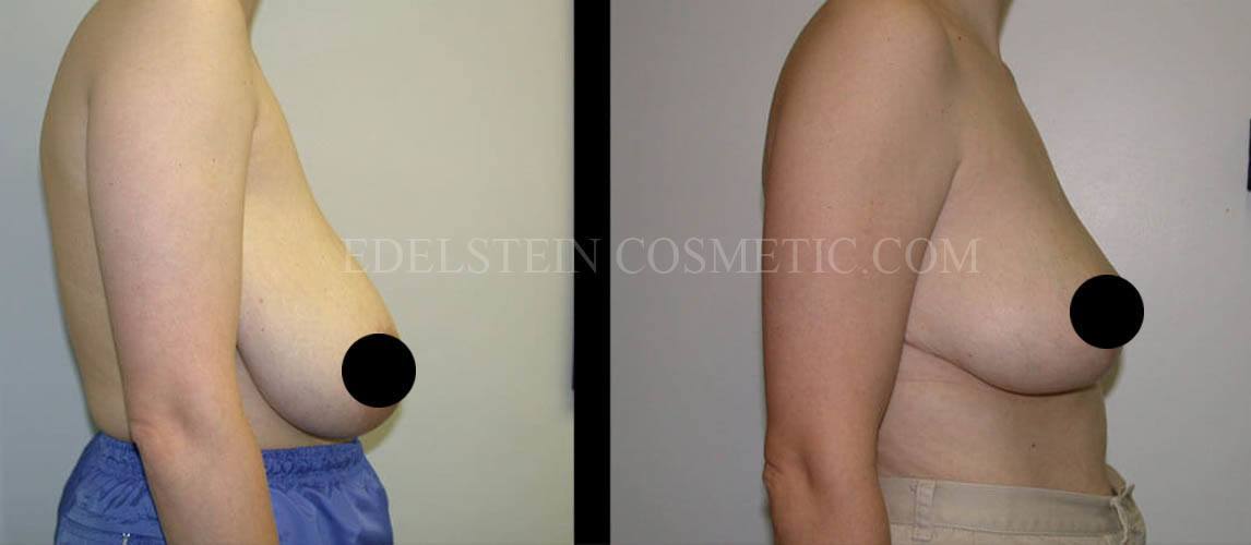 Breast Reduction case #26642
