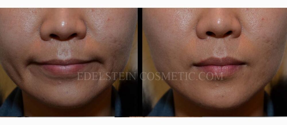 Lip Enhancement case #26718