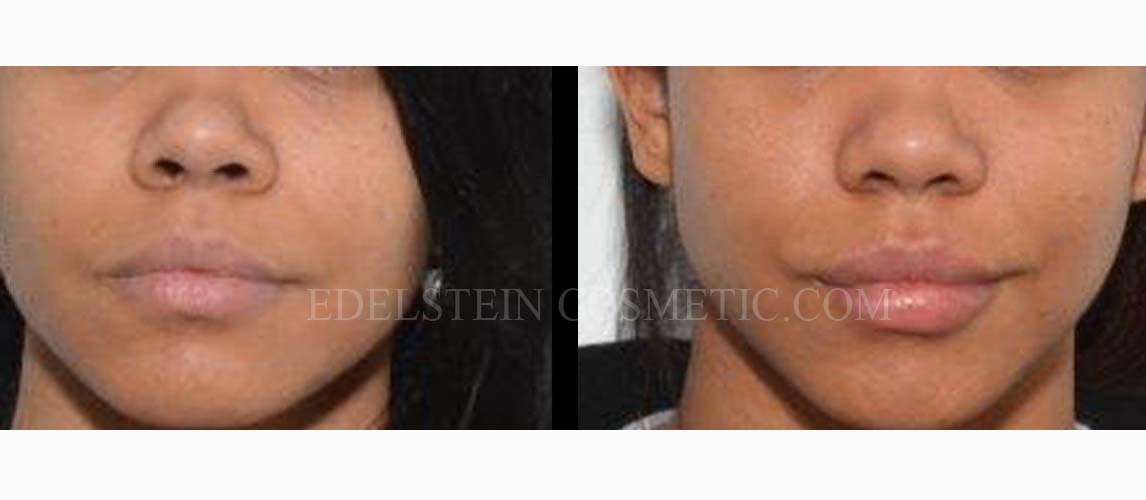 Lip Enhancement case #26716