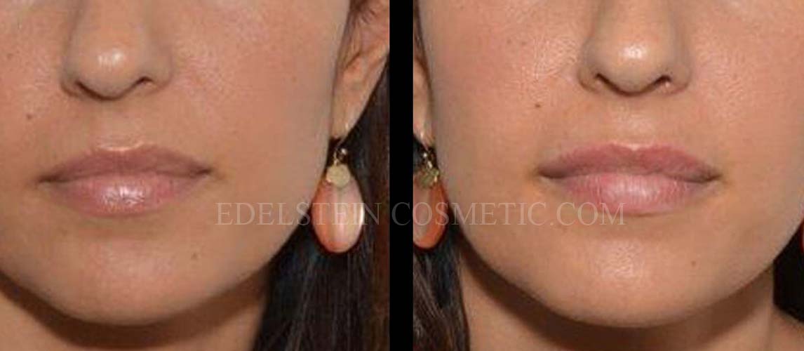 Lip Enhancement case #26711