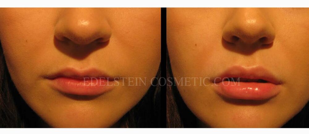 Lip Enhancement case #26728