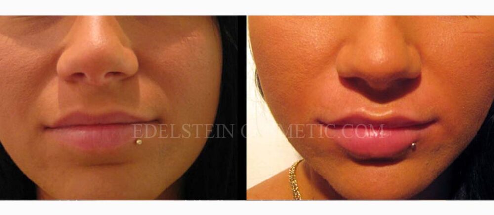 Lip Enhancement case #26721