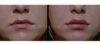 Lip Enhancement case #26719 slider thumbnail