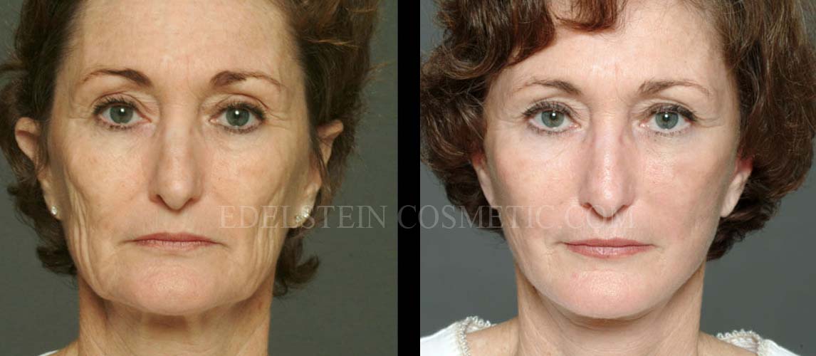 Facelift/Neck Lift case #26803