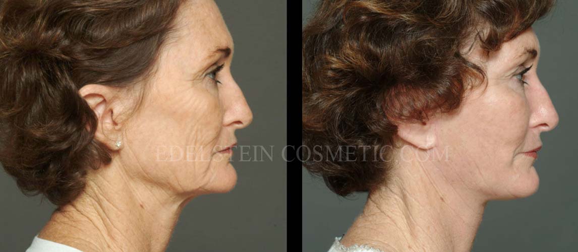 Facelift/Neck Lift case #26803