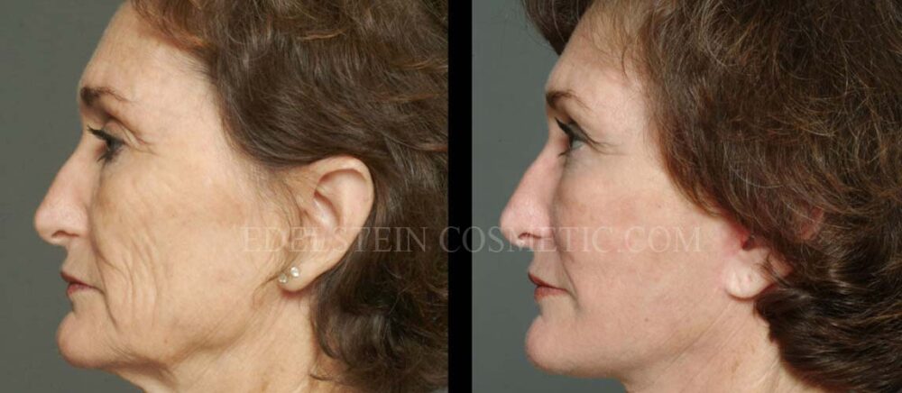 Facelift/Neck Lift case #26803