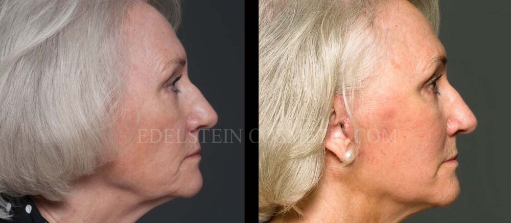 Facelift/Neck Lift case #26804