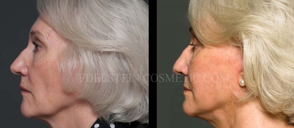 Facelift/Neck Lift case #26804