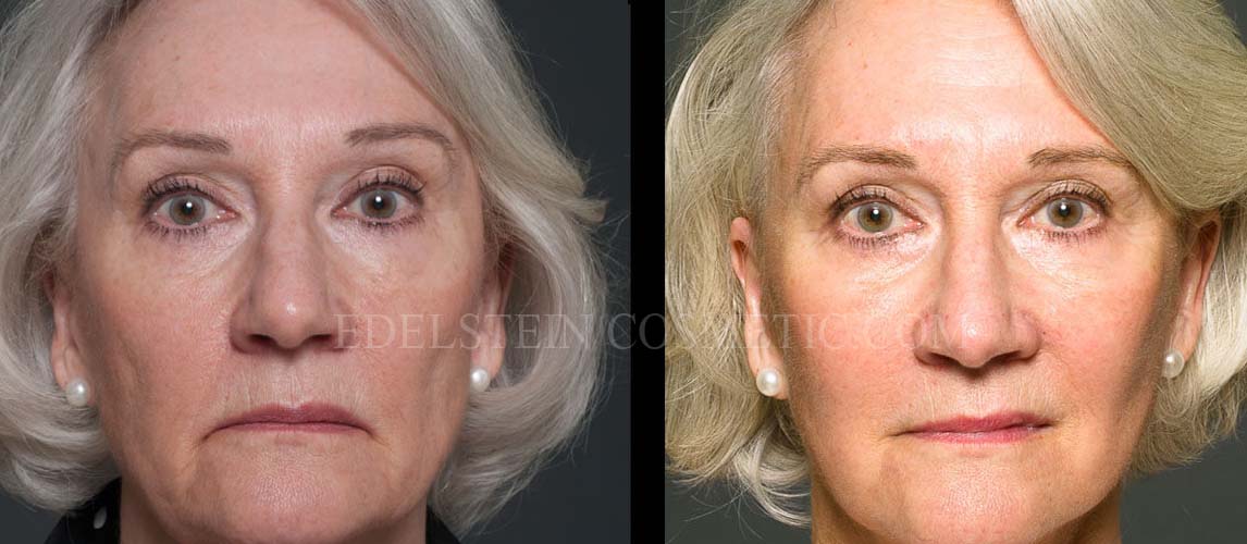 Facelift/Neck Lift case #26804