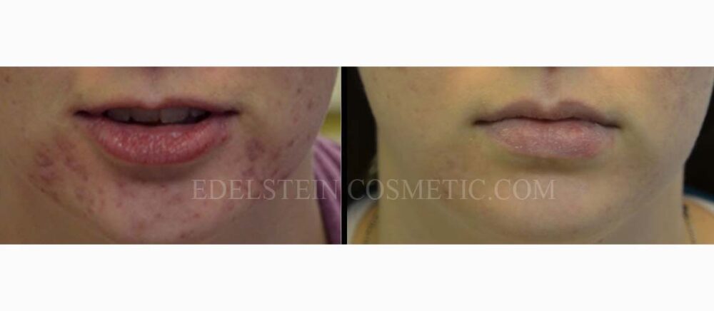 Facial Peel case #26699