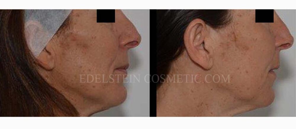 Facial Peel case #26705