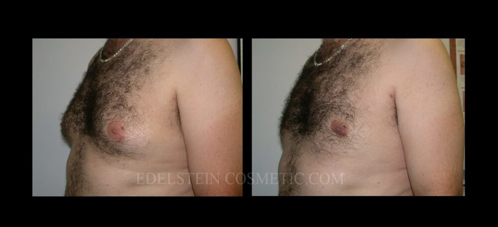 Gynecomastia case #26404