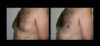 Gynecomastia case #26404 slider thumbnail