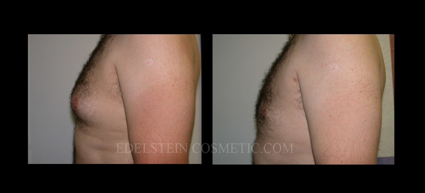 Gynecomastia case #26405